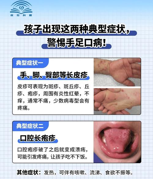 2016手足口病疫情-手足口病最近新闻